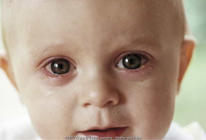 Mengatasi Mata Si Kecil yang Lemah