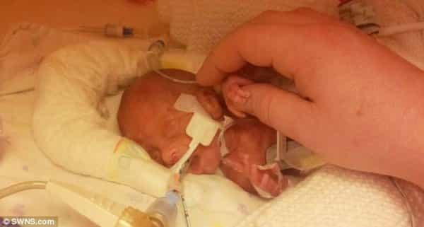 Kisah Kelahiran Bayi Prematur 1 Kilogram