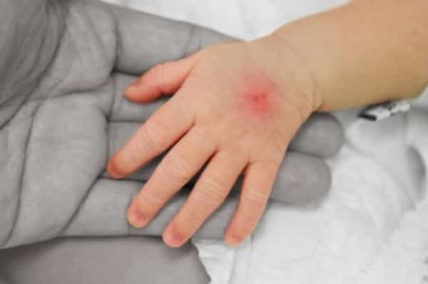 Mengenal Septicaemia (2)