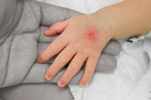Mengenal Septicaemia (2)