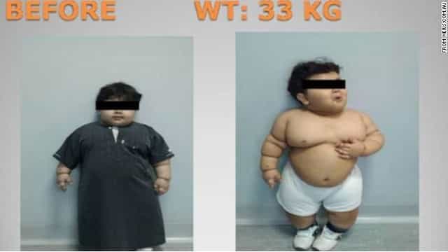 Balita Dioperasi karena Obesitas