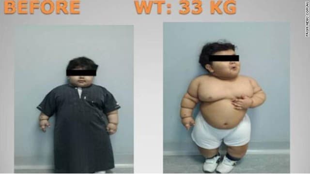 Balita Dioperasi karena Obesitas