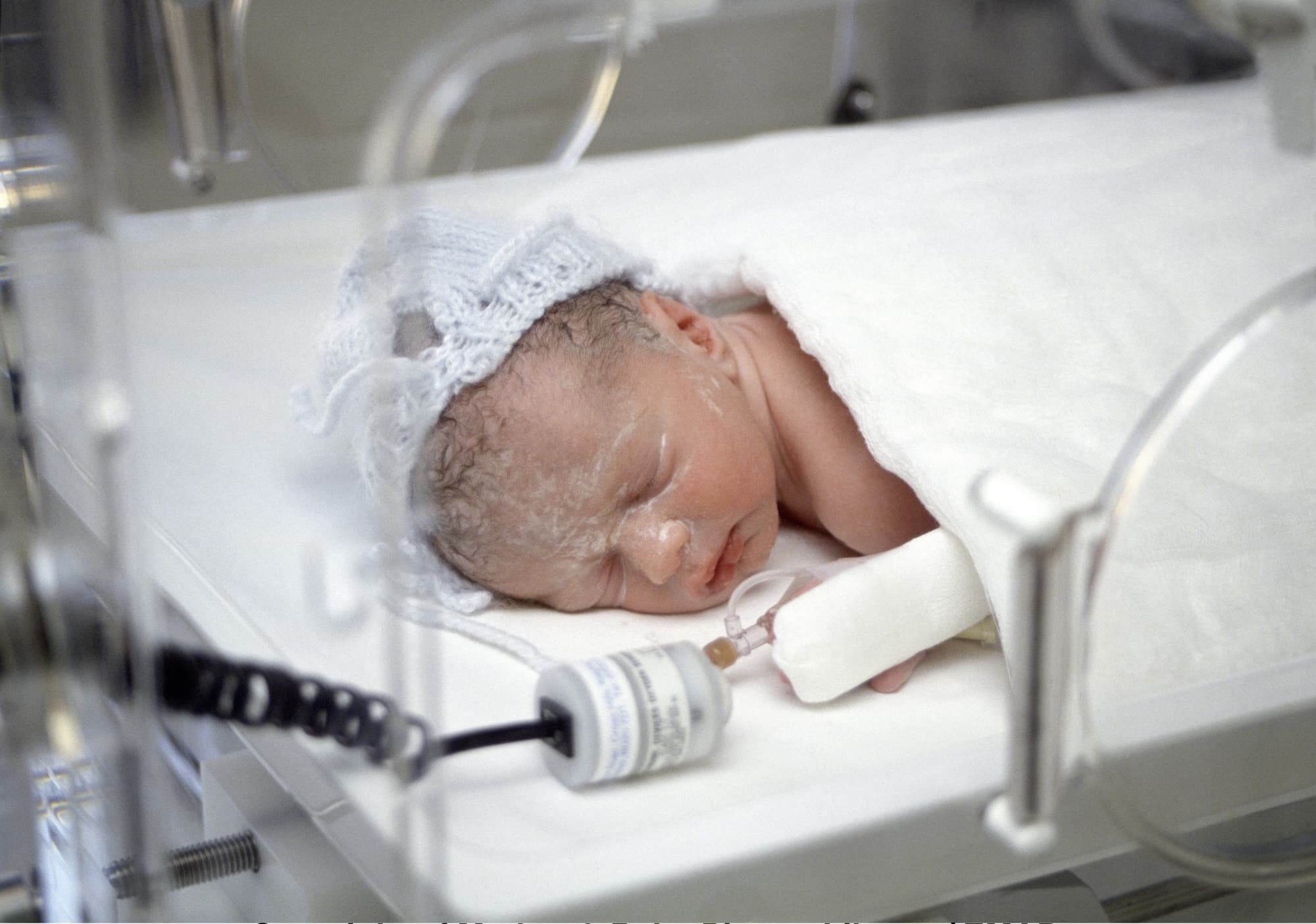 Bayi Prematur Rentan Diabetes