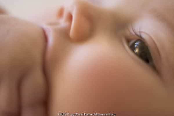 Infeksi Impetigo di Kulit Si Kecil
