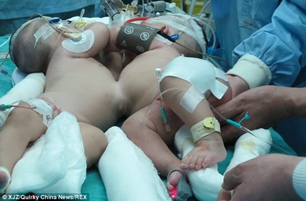 Bayi Kembar Dempet di Cina Berhasil Dipisahkan!