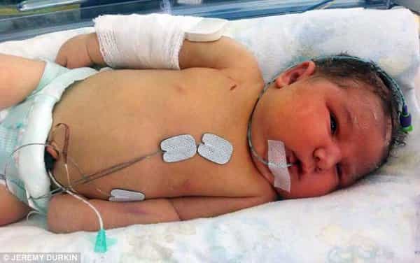 Bayi Dipatahkan Tangannya Agar Bisa Dilahirkan