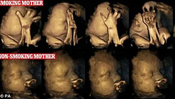 Hasil USG Bayi dengan Ibu Perokok