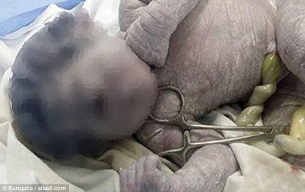 Bayi Bermata Satu Dilahirkan di Mesir