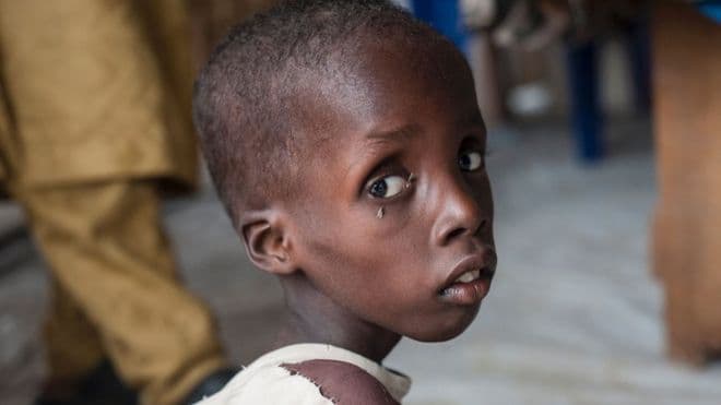 Ribuan Anak Nigeria Menderita Kekurangan Gizi Akut