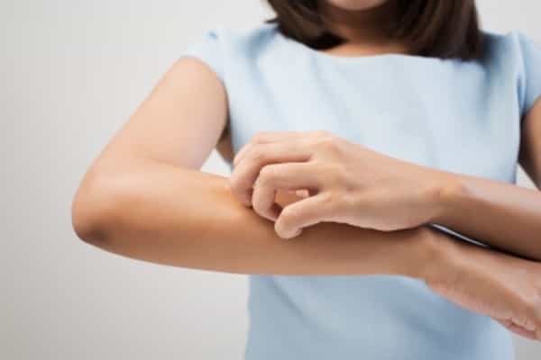 Tips Meredakan Biduran Akibat Urtikaria Dingin