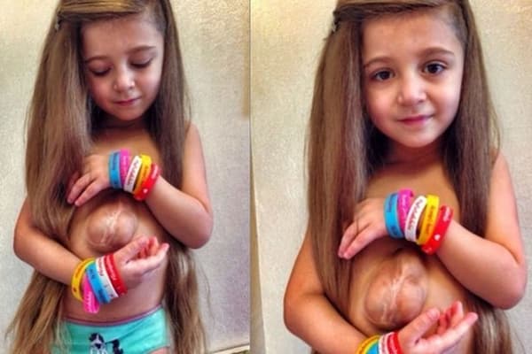 Jantung Anak Ini Berada Di Luar Tubuh