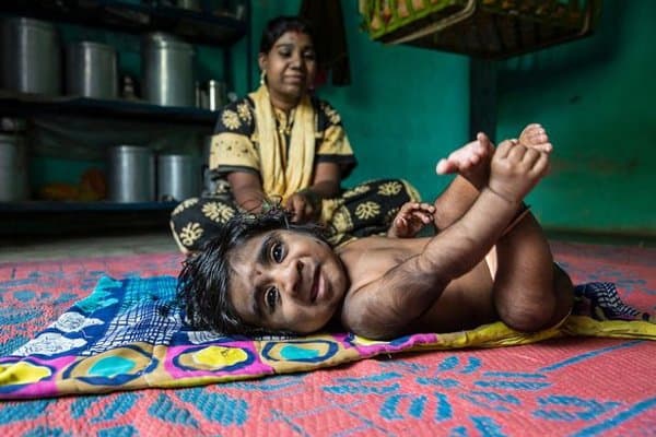 Kelainan Genetis, Bayi ini Jadi Werewolf