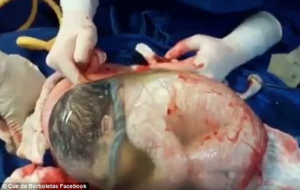 Bayi Ini Lahir Masih Terbungkus Kantung Ketuban!