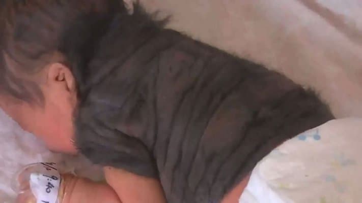 Astaga, Bayi ‘Werewolf’ Lahir di China!