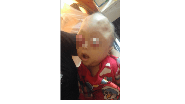 Bayi Asal Lampung Terserang Tumor Mata