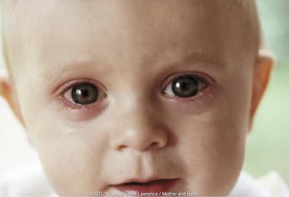 Meredakan Mata Merah pada Bayi