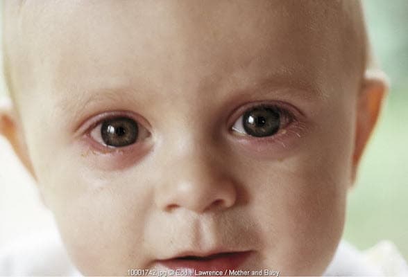 Meredakan Mata Merah pada Bayi