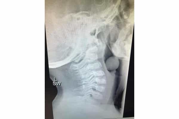 Waspada! Buah Anggur Berisiko Bikin Anak Tersedak