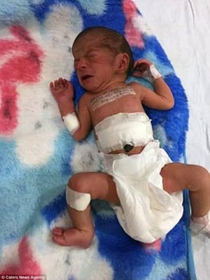 Bayi dengan Kembar Parasit Berhasil Dioperasi