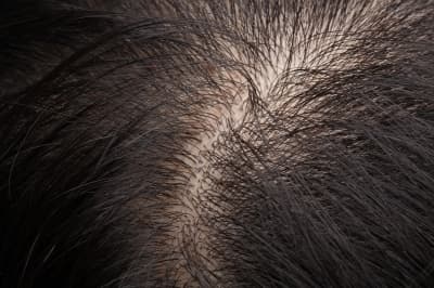 3 Masalah Rambut Yang Sering Dialami Pengguna Hijab