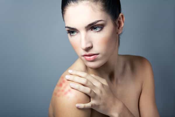 Bercak Merah Bersisik itu adalah Psoriasis