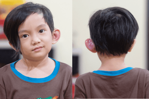 Anak Musisi Anji, Saga, Terkena Sinus Preauricular