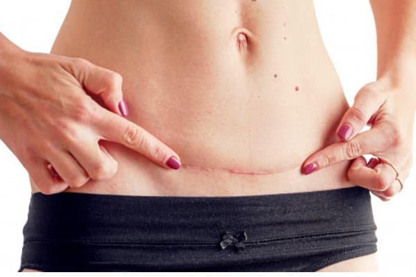 5 Fakta Penting seputar Keloid Pasca Operasi Caesar