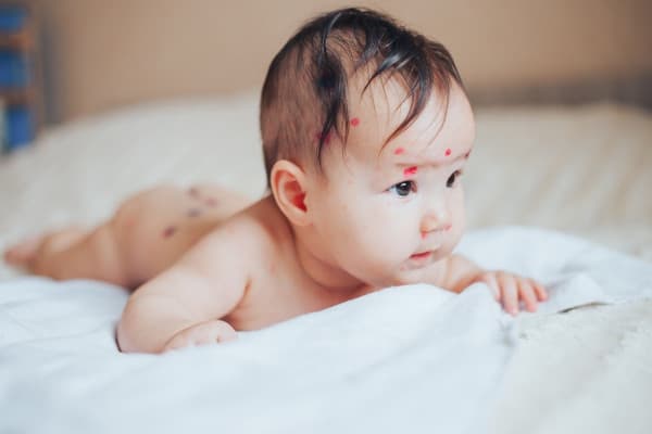 Waspadai 7 Masalah Kulit pada Bayi Baru Lahir