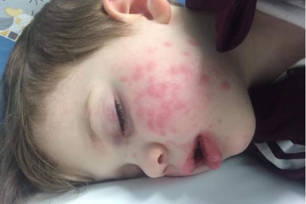 Sering Dicium, Balita Terjangkit Herpes dan Nyaris Buta