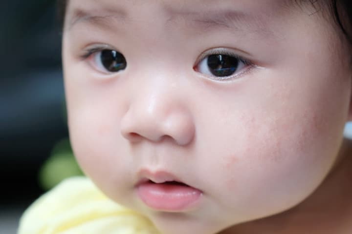 5 Penyebab Kulit Bayi Berjerawat dan Cara Mengatasinya