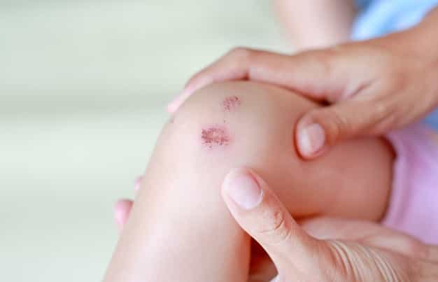 Bahaya Hemofilia pada Anak. Ini Gejala yang Perlu Diwaspadai