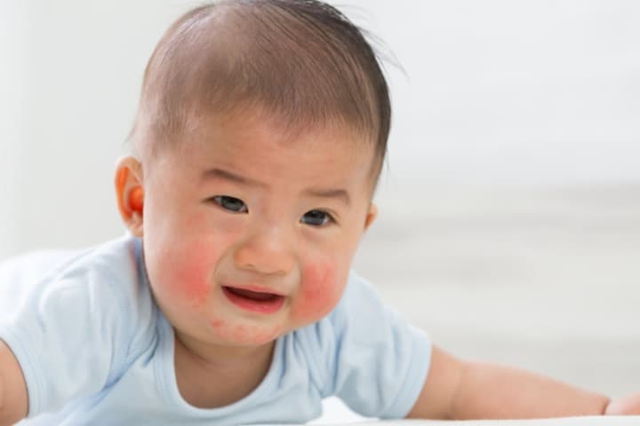 Mengenal Selulitis, Infeksi Bakteri yang Serang Kulit Bayi