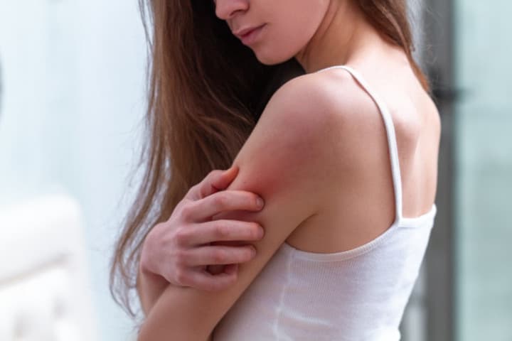 Dermatitis Atopik pada Orang Dewasa, Ini Cara Mengatasinya