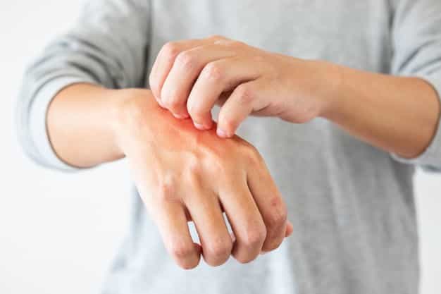 Hari Kusta Sedunia! Ketahui 10 Fakta Seputar Kusta di Indonesia
