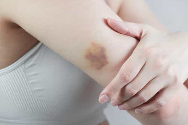 Tubuh Mudah Memar? Kenali 7 Tanda Kekurangan Vitamin K