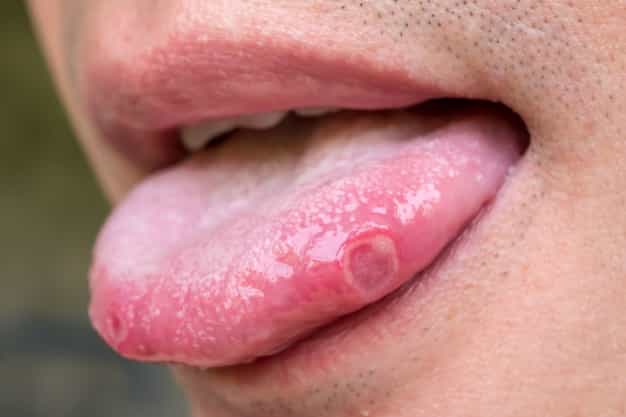 Covid Tongue, Gejala COVID-19 yang Mirip Sariawan