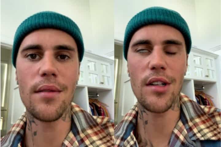 Kenali Ramsay Hunt Syndrome, Penyebab Wajah Justin Bieber Lumpuh
