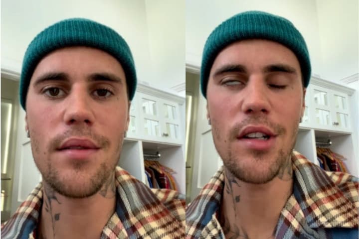 Kenali Ramsay Hunt Syndrome, Penyebab Wajah Justin Bieber Lumpuh