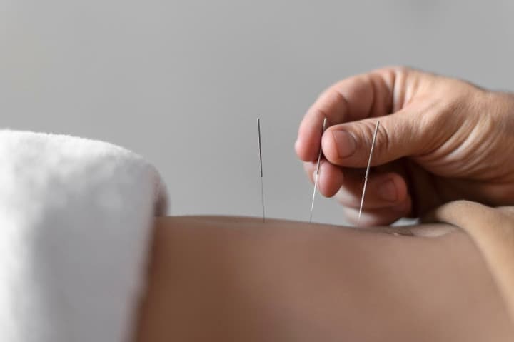 Sehat Tanpa Obat? Yuk, Kenali Serba-serbi Akupunktur Medik