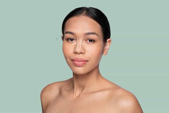 Jangan Tergiur Hasilnya, Kenali Dulu Risiko Tanam Benang Hidung