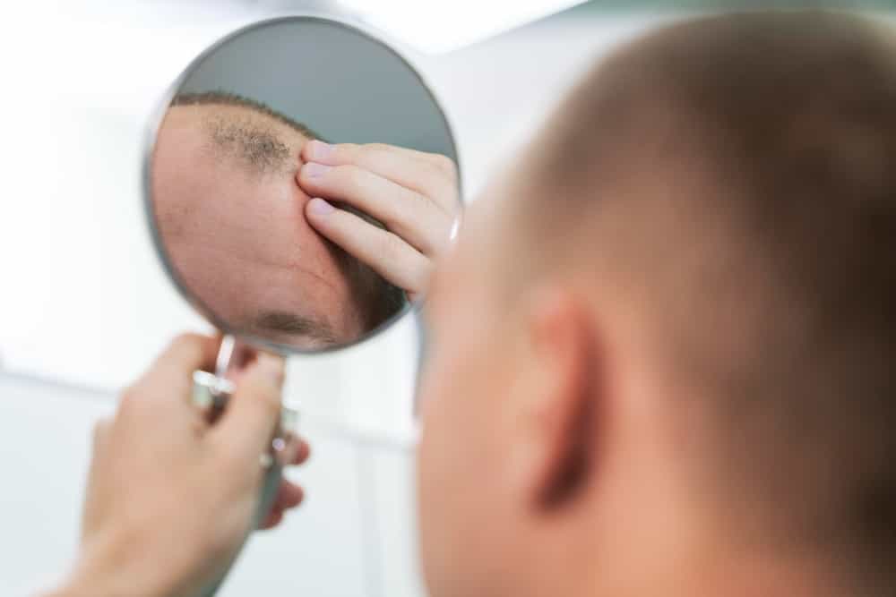 6 Hal yang Perlu Diketahui Seputar Tanam Rambut