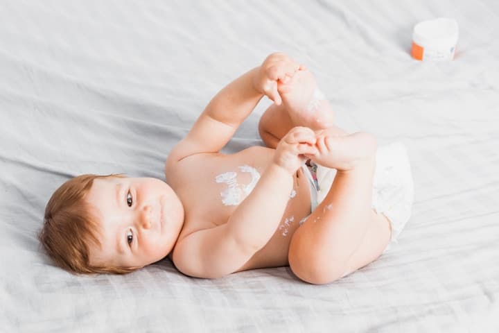 Bukan Panu! Ini Penyebab Munculnya Bercak Putih pada Kulit Bayi