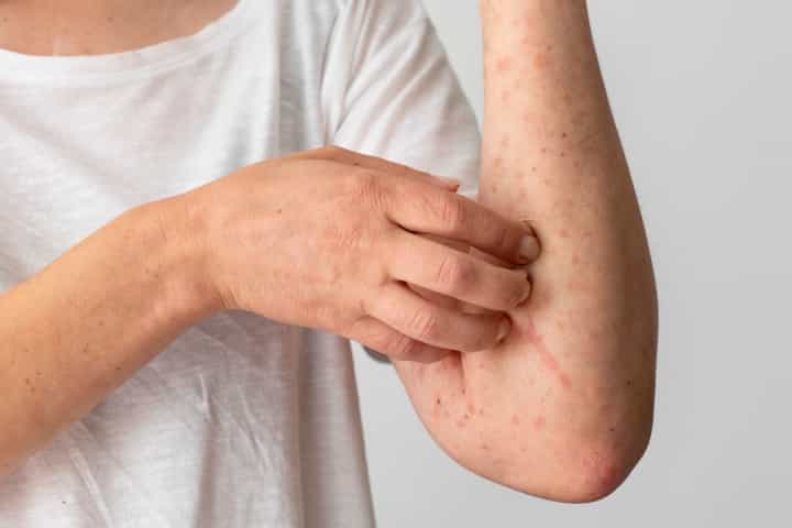 Mengenal Jenis-jenis Dermatitis dan Penyebabnya yang Perlu Anda Tahu